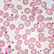 Hematopathology Subdivision